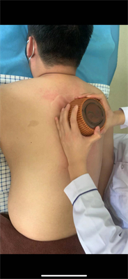 背部火龍罐治療.jpg